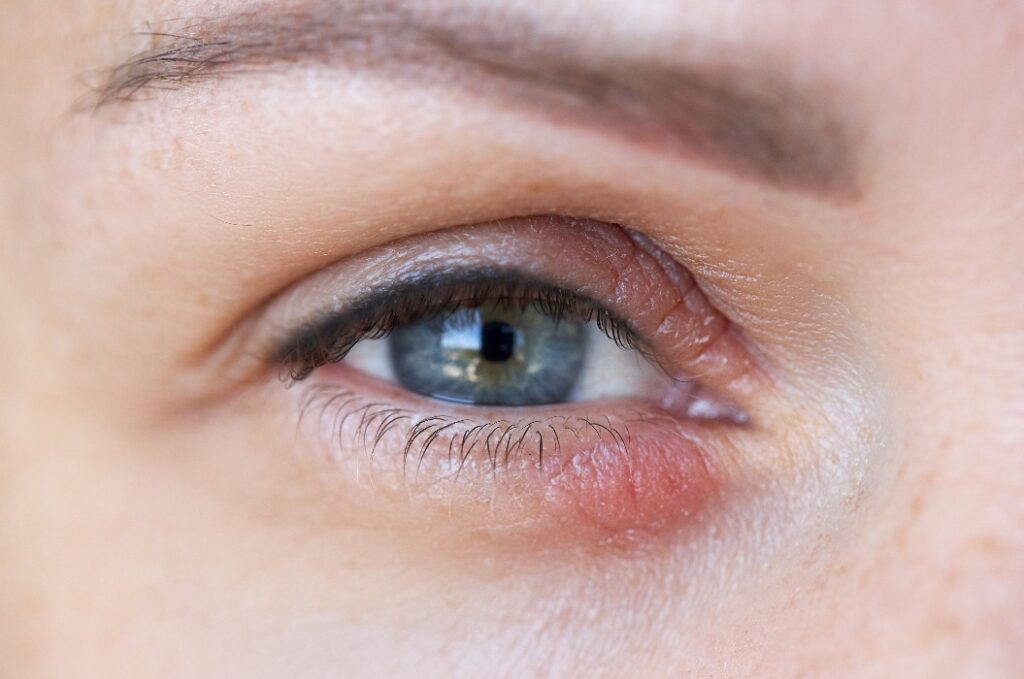 Schwellung auf dem Augenlid des menschlichen Auges aufgrund eines Tumors
